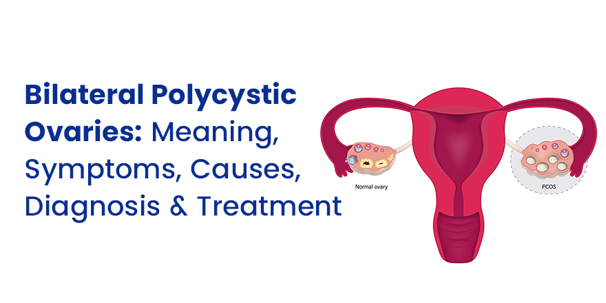 Bilateral Polycystic Ovaries: Meaning, Symptoms, Causes, Diagnosis and Treatment